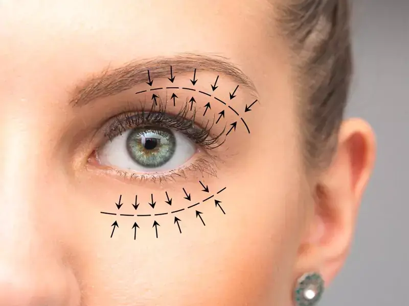 under-eye-bag-treatment-without-surgery