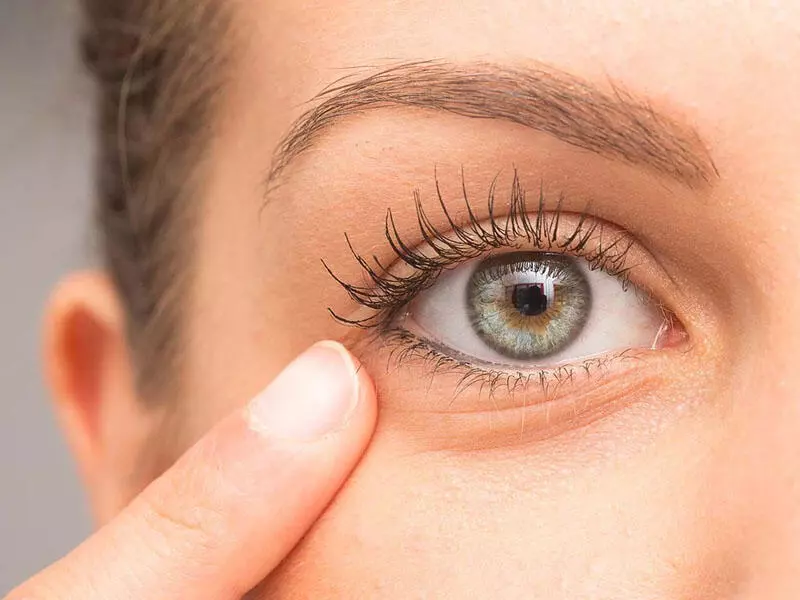 goz-alti-torbasi-ameliyati-sonrasi