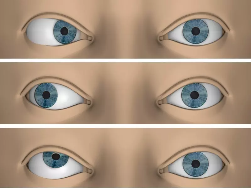 sasilik-ameliyati-strabismus-cerrahisi