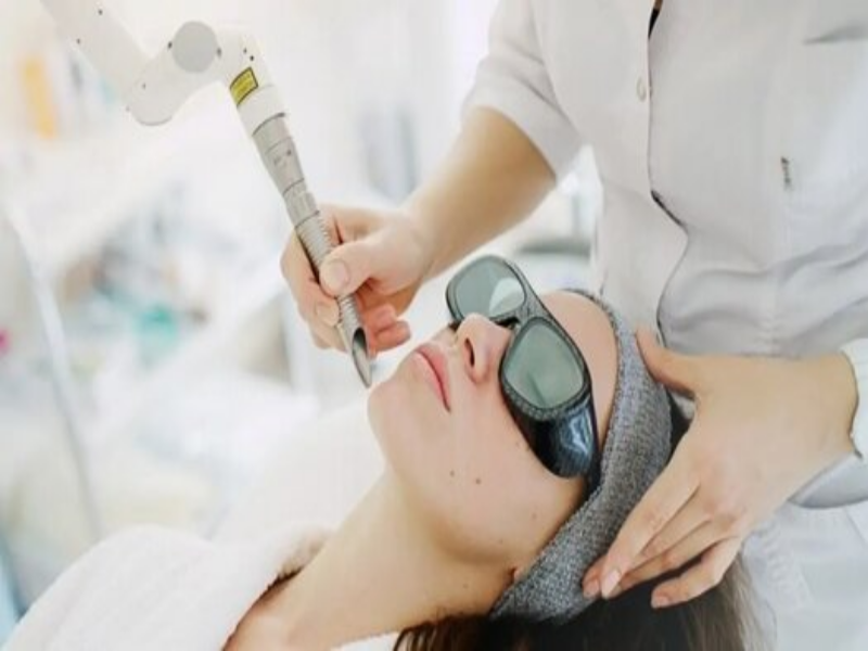 athens laser depigmentation