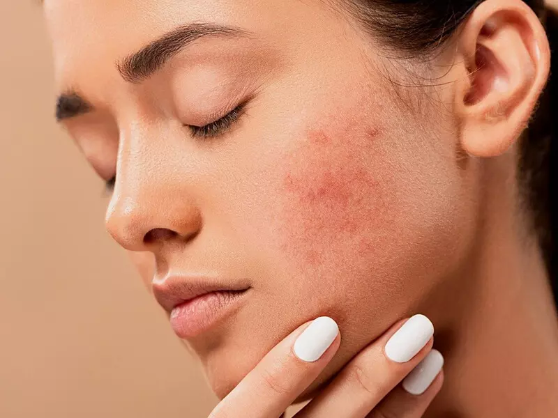 bogota laser depigmentation