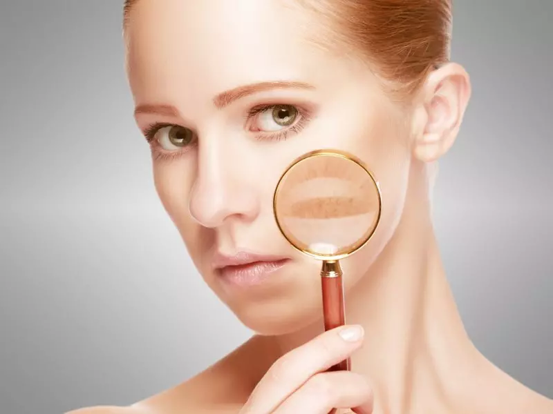 buenos aires laser depigmentation