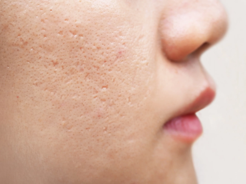 chicago laser depigmentation
