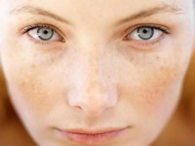 copenhang laser depigmentation