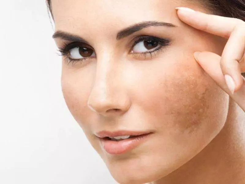 dubai laser depigmentation